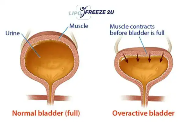 diagram of overactive bladder treatment Woking