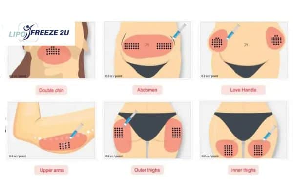 Benefits of Choosing Aqualyx for Fat Reduction Woking