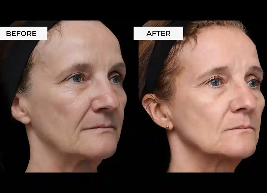 How Many RF Microneedling Sessions Will You Need to See a Difference Woking?