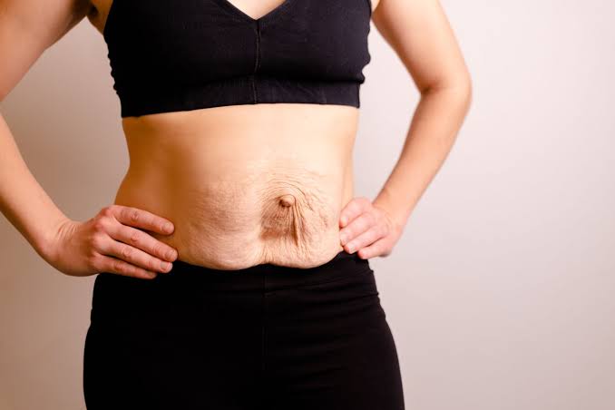 Is Surgery Really the Only Way to Repair Diastasis Recti Woking?