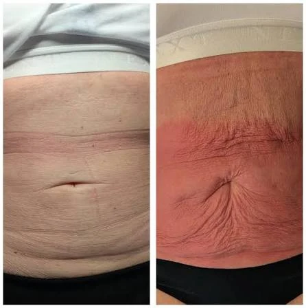 How Does RF Microneedling Improve Crepey, Thin and Uneven Skin Texture Woking?