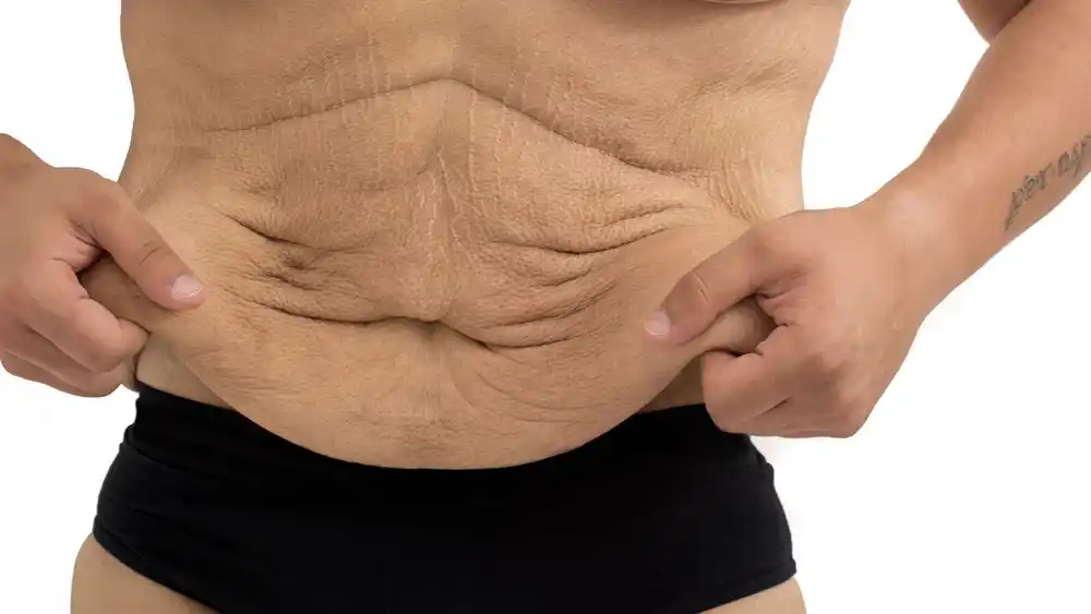 RF Microneedling for Loose Skin: How Can It Help Tighten and Reshape the Skin Woking?